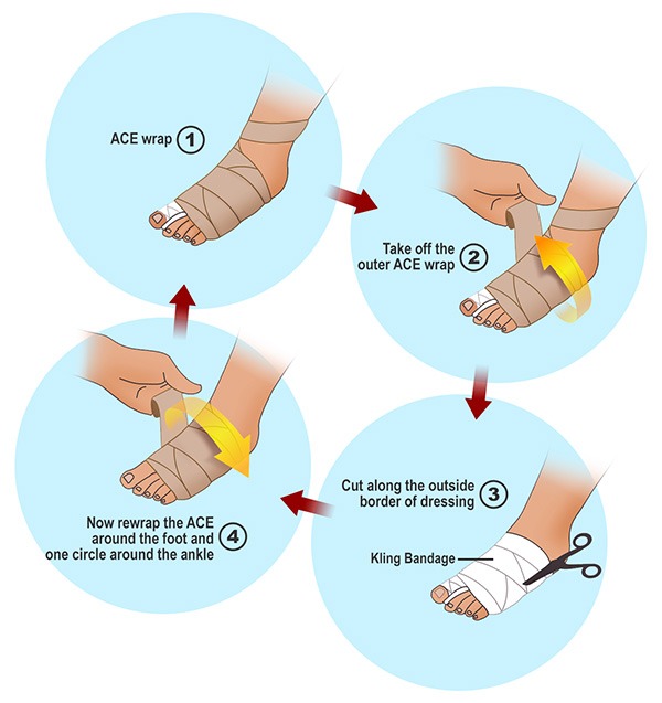 Bunion Surgery Dressing Directions